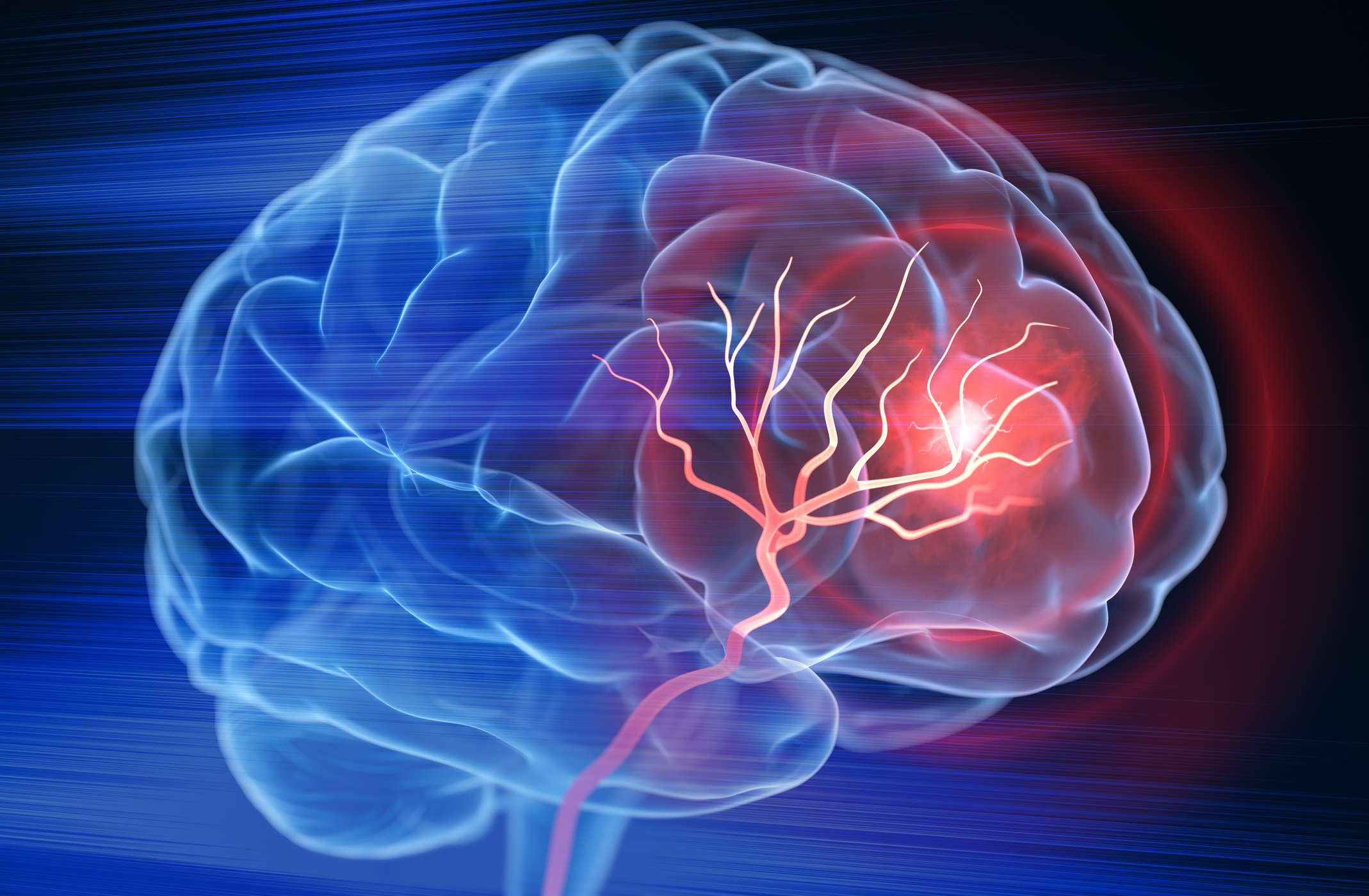 Recognizing stroke and aneurysm symptoms help patients receive lifesaving treatments in time