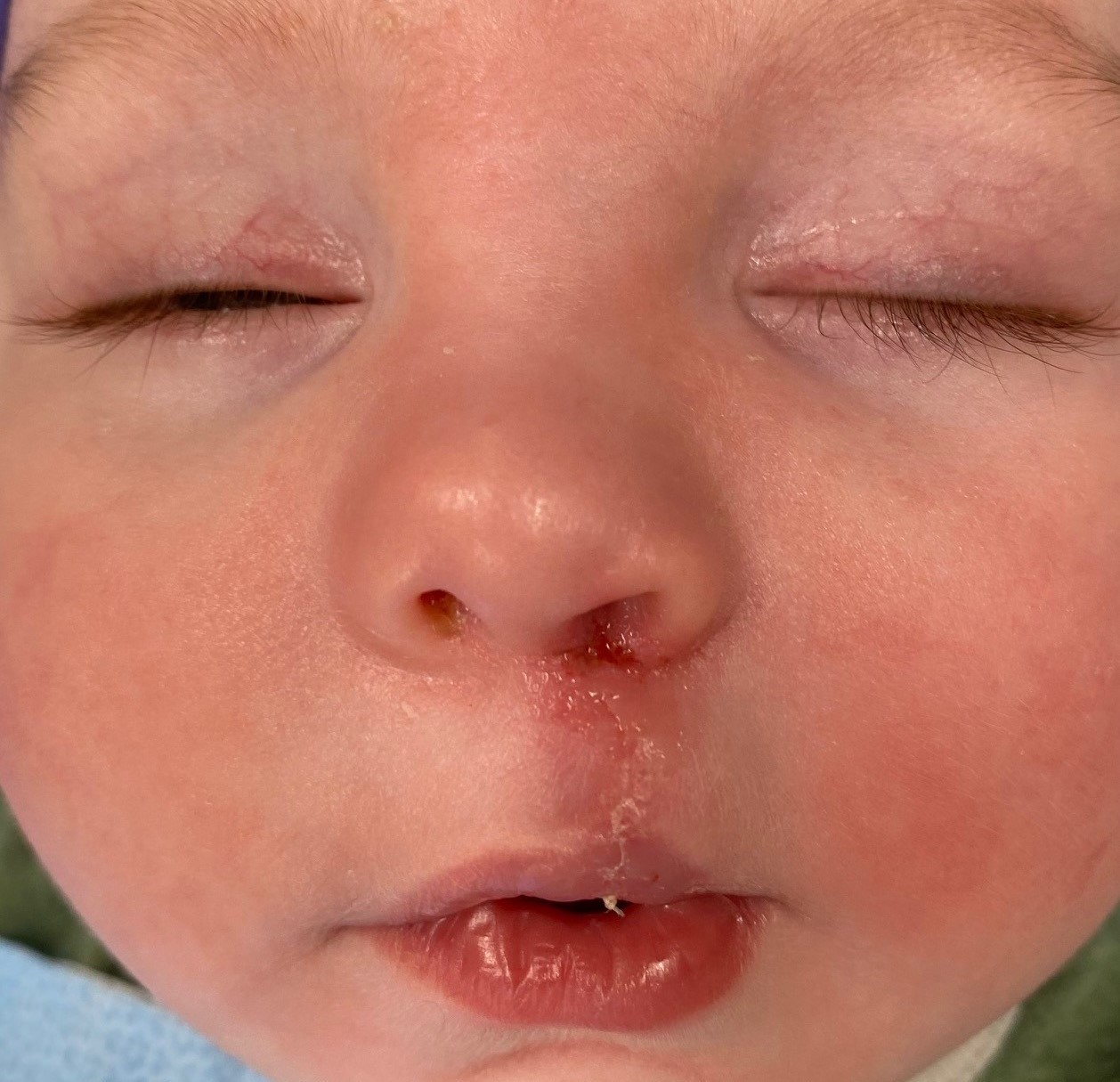 Tate-Sawyer,Early-Post-Surgery-vs-3.jpg Tate-Sawyer post surgery